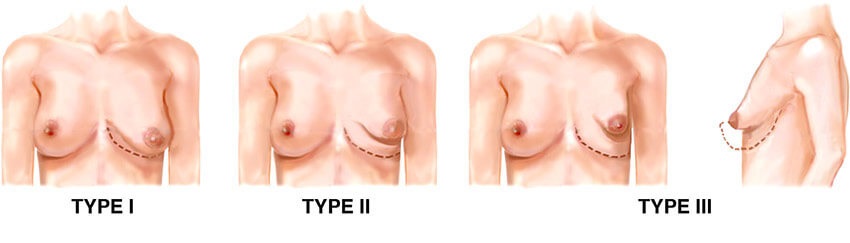 Treatment of Tuberous Breasts
